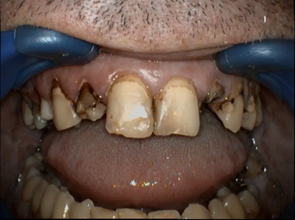 Case 7 before Zirconia Crowns treament Dr Conor Molloy